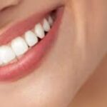 Beautiful Smiles with Veneers in London