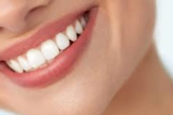 Beautiful Smiles with Veneers in London